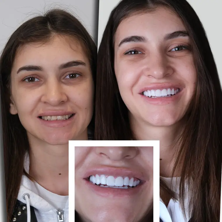 Alexandra C. - Coroane Zirconiu