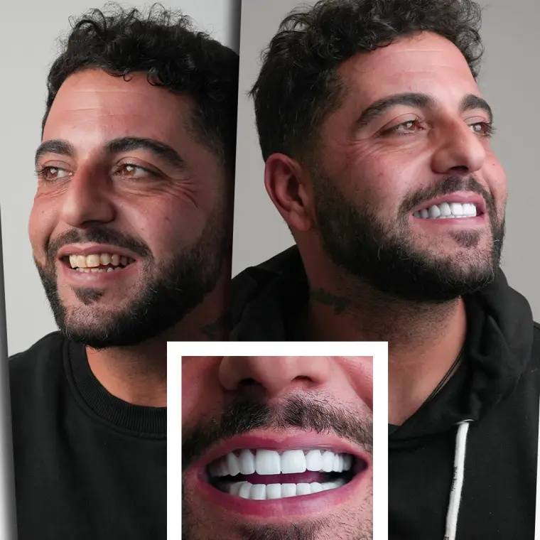 Hassan M. - Implanturi All-on-4