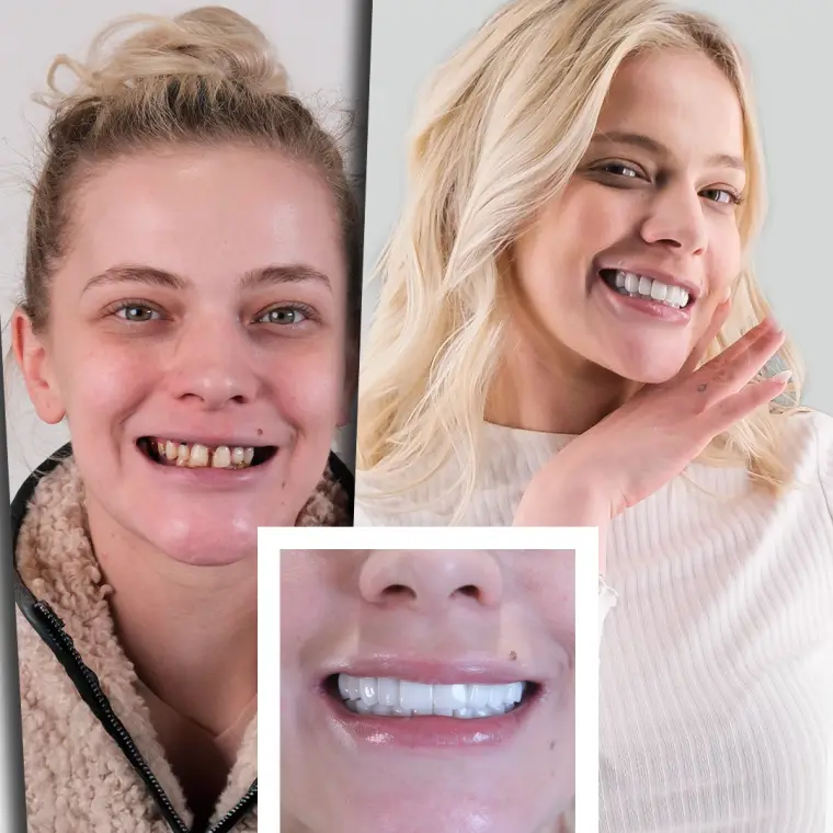 Jasmin B. - Digital Smile Design